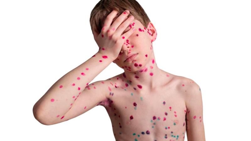 مرض جدري القرود 