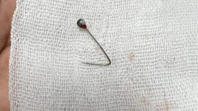 بلعت دبوس استقر في رئتها .. فريق طبي ينقذ حياة فتاة بعملية جراحية في بنها