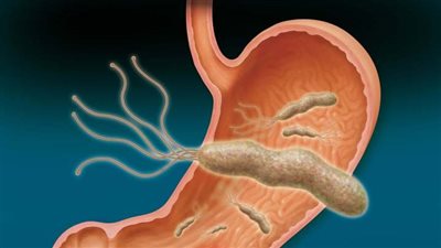 ما أعراض وأسباب جرثومة المعدة؟ وكيف يمكن علاجها؟ (إنفوجراف)